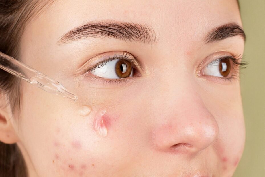 Acne-prone skincare routine with gentle cleanser, lightweight moisturizer, and targeted treatment products arranged neatly.